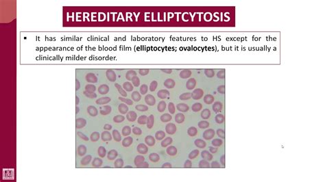 hereditary elliptocytosis life expectancy|Hereditary elliptocytosis Information .